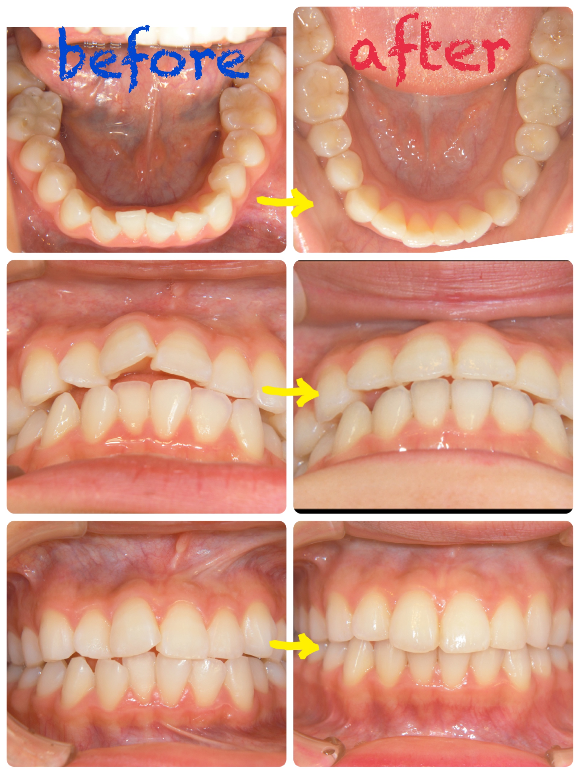 ついに！マウスピース矯正終わりました！