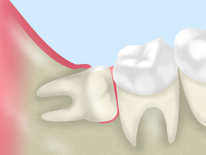 親知らずが痛む