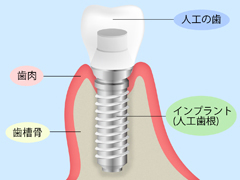 インプラントとは